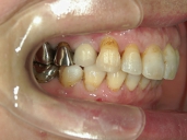 矯正歯科　治療後　右