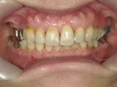 矯正歯科　治療後　正面