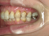 矯正歯科　治療後　左
