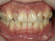 矯正歯科　治療前