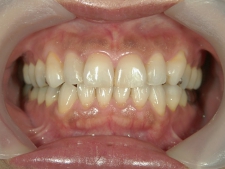 矯正歯科　プチワイヤー矯正　治療後