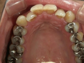 矯正歯科　治療前　上顎