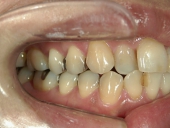 矯正歯科　治療前　右