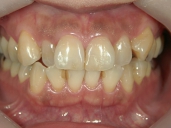 矯正歯科　治療前　正面