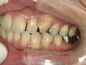 矯正歯科　治療前　左