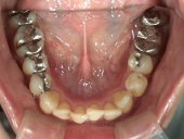 矯正歯科　治療前　下顎