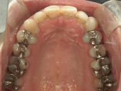 矯正歯科　治療後　上顎