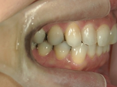 矯正歯科　治療後　右