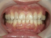 矯正歯科　治療後　正面