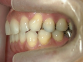 矯正歯科　治療後　左