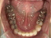 矯正歯科　治療後　下顎