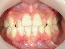 矯正歯科　治療前