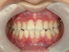 矯正歯科　プチワイヤー矯正　治療後