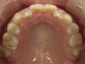 矯正歯科　治療前　上顎