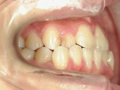 矯正歯科　治療前　右