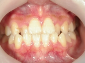 矯正歯科　治療前　正面