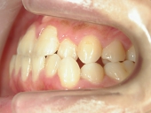 矯正歯科　治療前　左