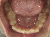 矯正歯科　治療前　下顎