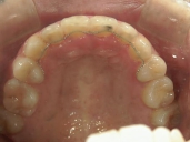 矯正歯科　治療後　上顎