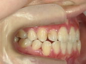 矯正歯科　治療後　右