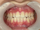 矯正歯科　治療後　正面