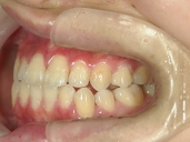 矯正歯科　治療後　左