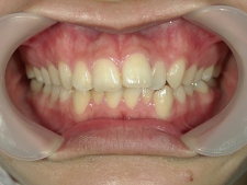 矯正歯科　治療前