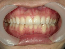 矯正歯科　プチワイヤー矯正　治療後