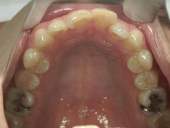 矯正歯科　治療前　上顎