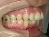 矯正歯科　治療前　右