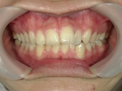 矯正歯科　治療前　正面