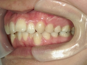 矯正歯科　治療前　左