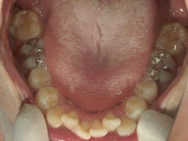 矯正歯科　治療前　下顎