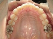 矯正歯科　治療後　上顎