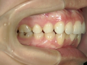 矯正歯科　治療後　右