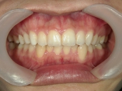 矯正歯科　治療後　正面