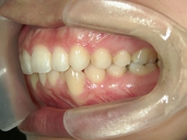 矯正歯科　治療後　左