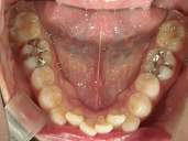 矯正歯科　治療後　下顎