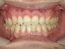 矯正歯科　プチワイヤー矯正　治療後