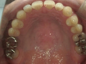 矯正歯科　治療前　上顎