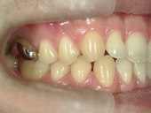 矯正歯科　治療前　右