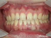 矯正歯科　治療前　正面