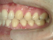矯正歯科　治療前　左
