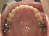 矯正歯科　治療後　上顎