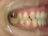 矯正歯科　治療後　右