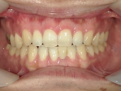 矯正歯科　治療後　正面