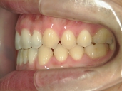矯正歯科　治療後　左