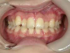 矯正歯科　治療前