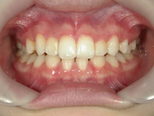 矯正歯科　プチワイヤー矯正　治療後