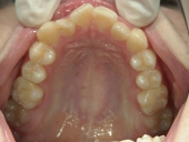 矯正歯科　治療前　上顎